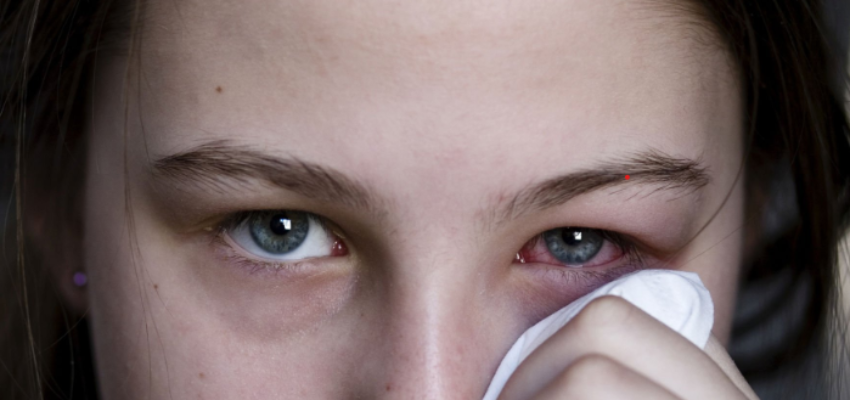 what is commonly misdiagnosed as pink eye