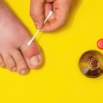 Ingrown Toenail With Diabetes