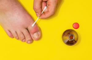 Ingrown Toenail With Diabetes