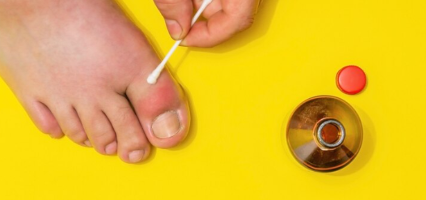 Ingrown Toenail With Diabetes